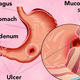 Illustration for article titled Obat Maag Tradisional Yang Ampuhem/em